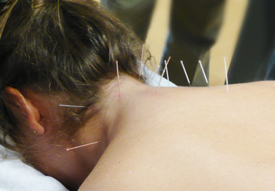 Dry Needling Service at EXL Physiotherapy, Carlingford NSW